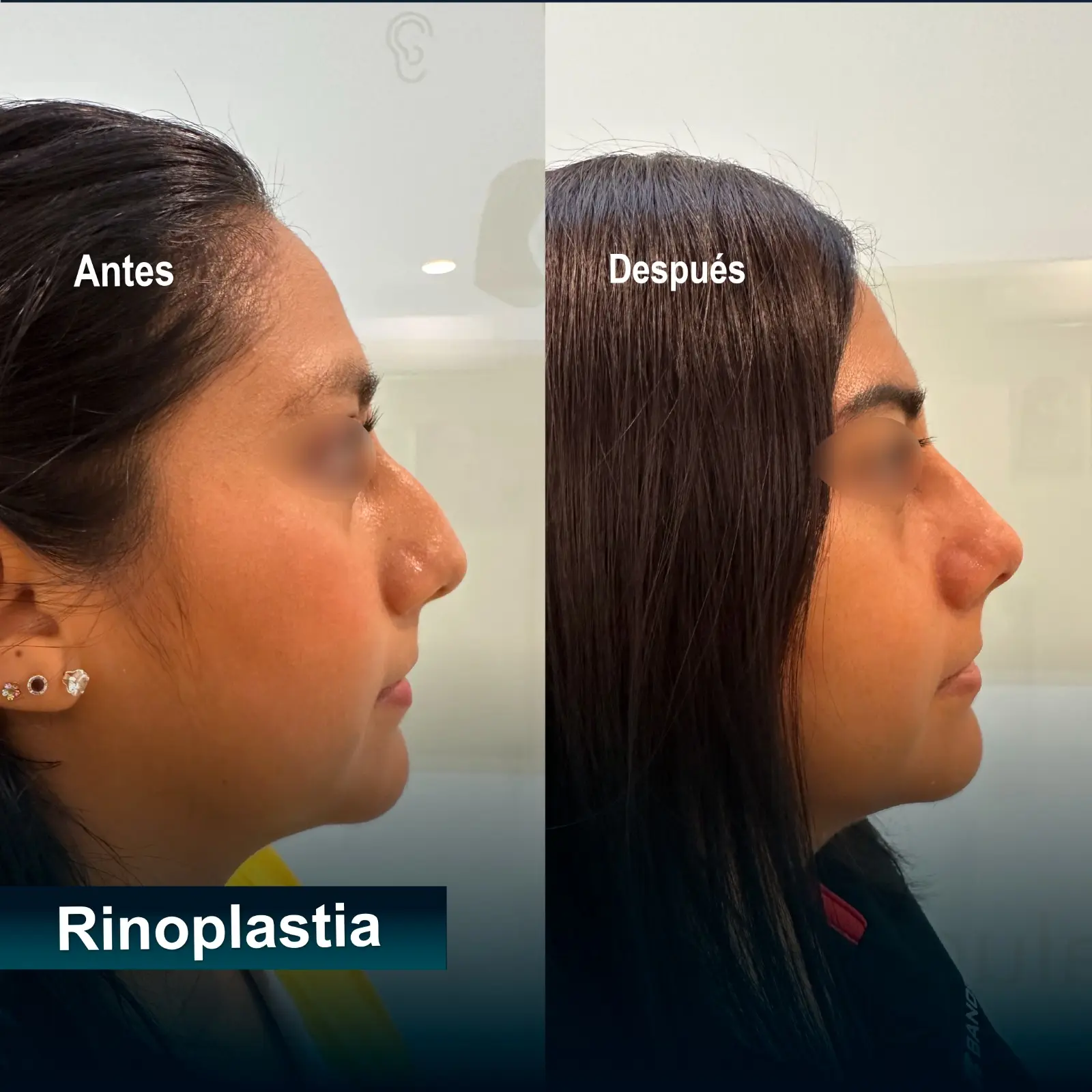 rinoplastia caso exito