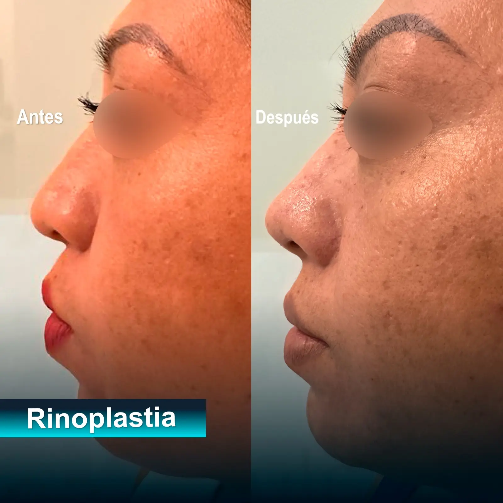 rinoplastia caso exito