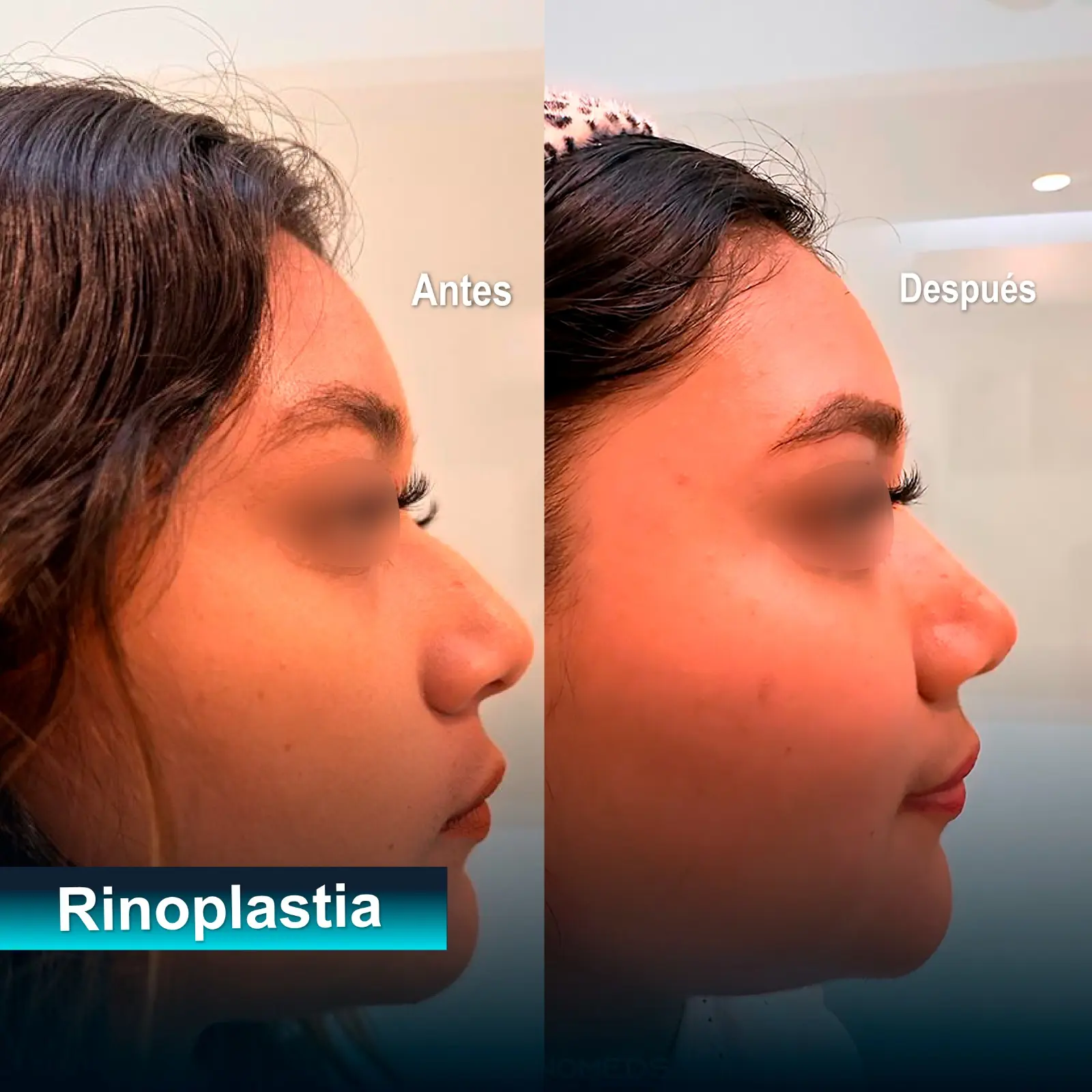 rinoplastia caso exito