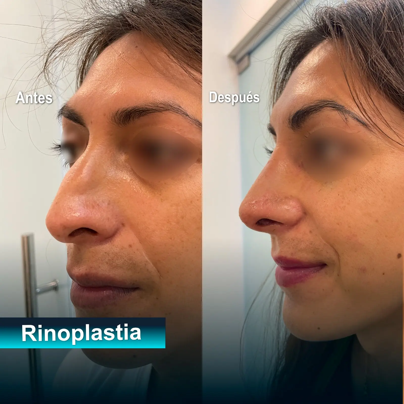 rinoplastia caso exito