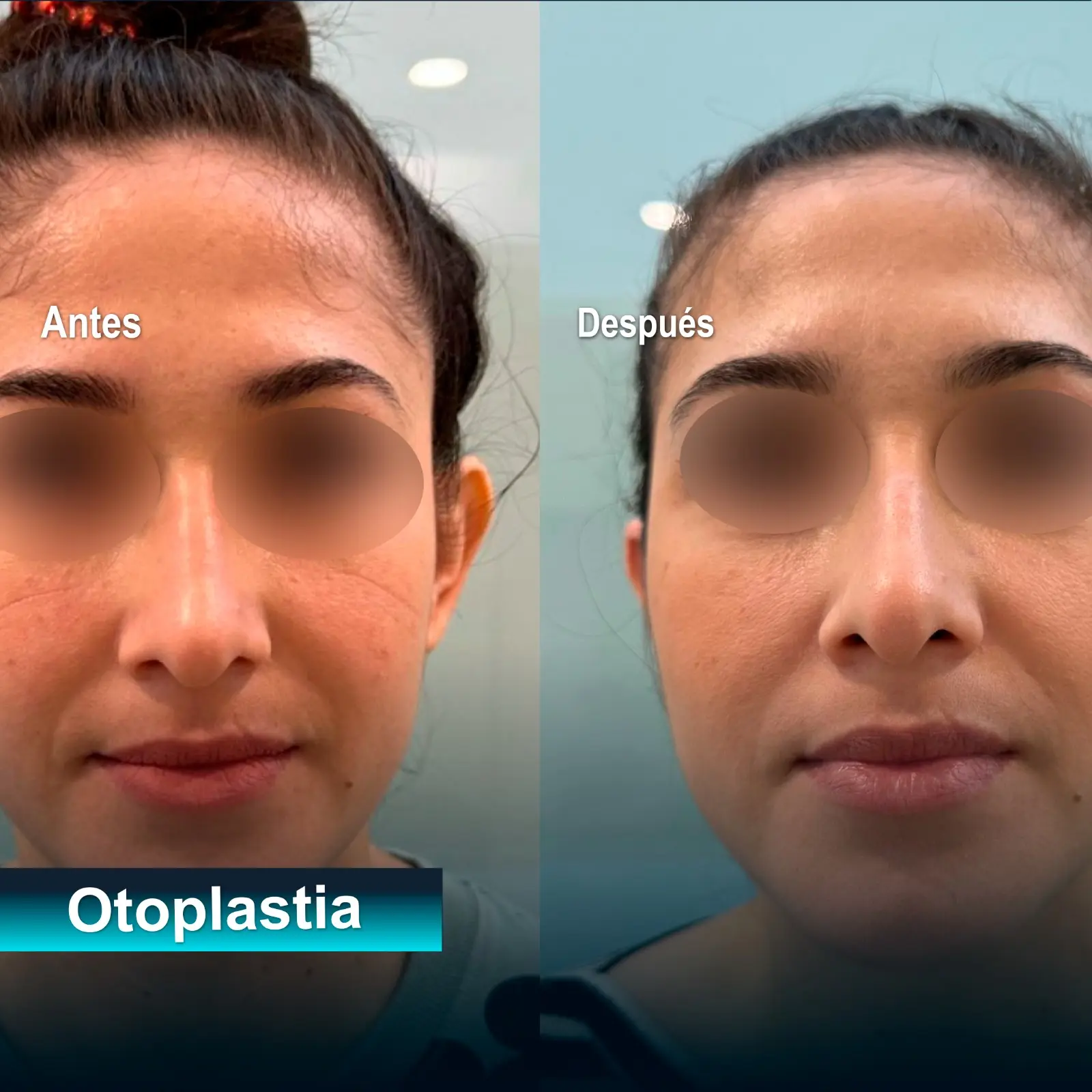 rinoplastia caso exito